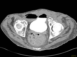 Fistulae to Thigh on CT Cystogram in Patient With Recurrent Tumor in Left Thigh - CTisus CT Scan