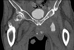 Fistulae to Thigh on CT Cystogram in Patient With Recurrent Tumor in Left Thigh - CTisus CT Scan