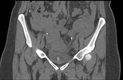 CT Cystogram With Pancreatic Transplant and Pseudo Leak - CTisus CT Scan