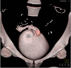 CT Cystogram With Pancreatic Transplant and Pseudo Leak - CTisus CT Scan