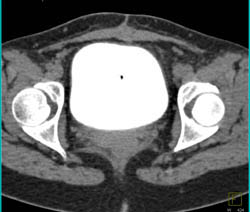 CT Cystogram With Pancreatic Transplant and Pseudo Leak - CTisus CT Scan