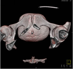 CT Cystogram With Pancreatic Transplant and Pseudo Leak - CTisus CT Scan