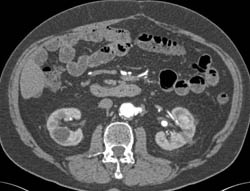 Implants on Bladder From Carcinoid Tumor - CTisus CT Scan