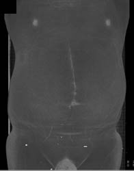 Implants on Bladder From Carcinoid Tumor - CTisus CT Scan