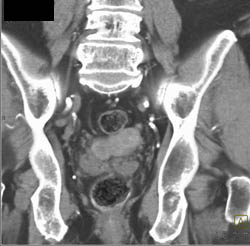 Implants on Bladder From Carcinoid Tumor - CTisus CT Scan