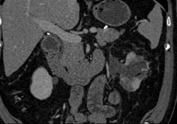 Complication With Leak S/p Left Cryoablation - CTisus CT Scan