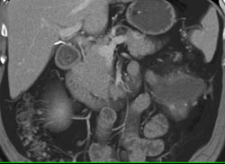 Complication With Leak S/p Left Cryoablation - CTisus CT Scan