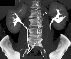 Complication With Leak S/p Left Cryoablation - CTisus CT Scan