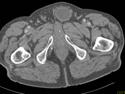 Bladder Herniates Through Defect - CTisus CT Scan