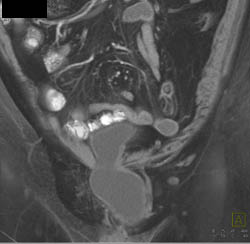 Bladder Herniates Through Defect - CTisus CT Scan