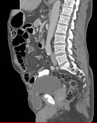 Bladder Herniates Through Defect - CTisus CT Scan