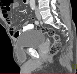 Bladder Herniates Through Defect - CTisus CT Scan