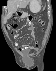 Bladder Herniates Through Defect - CTisus CT Scan