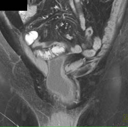 Bladder Herniates Through Defect - CTisus CT Scan