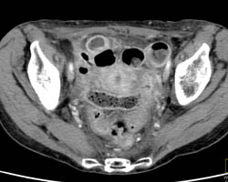 Radiation Cystitis and Proctitis - CTisus CT Scan