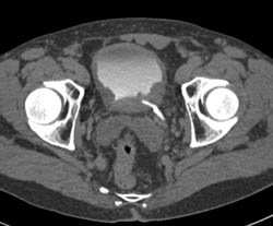 Bladder Cancer - CTisus CT Scan