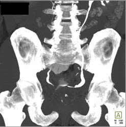 Bladder Cancer - CTisus CT Scan