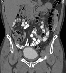 Bladder Cancer - CTisus CT Scan