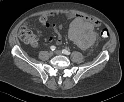 Unusual Liposarcoma in Llq - CTisus CT Scan