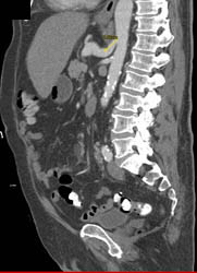 Unusual Liposarcoma in Llq - CTisus CT Scan