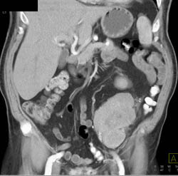 Unusual Liposarcoma in Llq - CTisus CT Scan