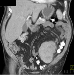 Unusual Liposarcoma in Llq - CTisus CT Scan