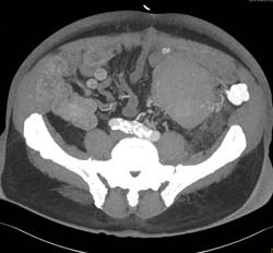 Unusual Liposarcoma in Llq - CTisus CT Scan