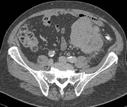 Unusual Liposarcoma in Llq - CTisus CT Scan