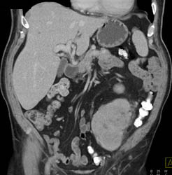 Unusual Liposarcoma in Llq - CTisus CT Scan