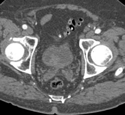 Bladder Cancer- Subtle Early - CTisus CT Scan