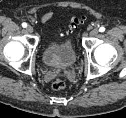 Bladder Cancer- Subtle Early - CTisus CT Scan