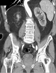 Bladder Cancer- Subtle Early - CTisus CT Scan