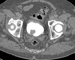 Bladder Cancer- Subtle Early - CTisus CT Scan