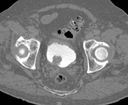 Bladder Cancer- Subtle Early - CTisus CT Scan