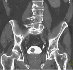 Bladder Cancer- Subtle Early - CTisus CT Scan