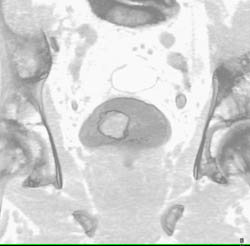 Bladder Cancer- Subtle Early - CTisus CT Scan