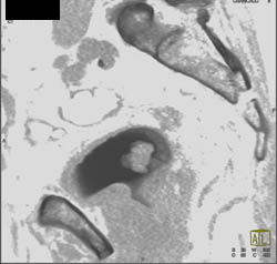 Bladder Cancer- Subtle Early - CTisus CT Scan