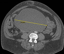 Germ Cell Tumor - CTisus CT Scan