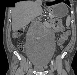 Germ Cell Tumor - CTisus CT Scan