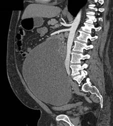 Germ Cell Tumor - CTisus CT Scan