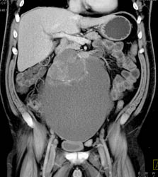 Germ Cell Tumor - CTisus CT Scan