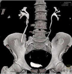 Germ Cell Tumor - CTisus CT Scan