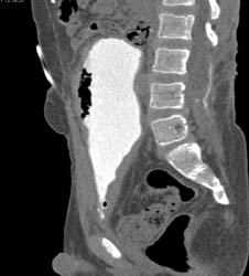 CT Cystogram in Augmented Bladder - CTisus CT Scan