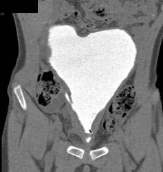 CT Cystogram in Augmented Bladder - CTisus CT Scan