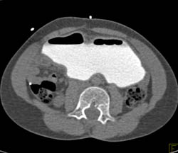 CT Cystogram in Augmented Bladder - CTisus CT Scan