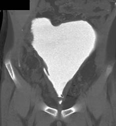 CT Cystogram in Augmented Bladder - CTisus CT Scan