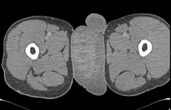 Scrotal Hematoma - CTisus CT Scan