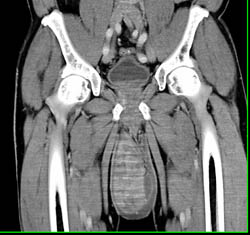 Scrotal Hematoma - CTisus CT Scan