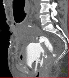 Fistulae From Bladder to Colon - CTisus CT Scan