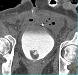 Fistulae From Bladder to Colon - CTisus CT Scan